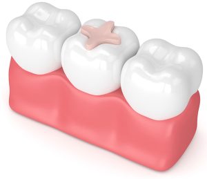 Dental Inlays & Onlays Gloucester, ON | Restore Decayed Teeth